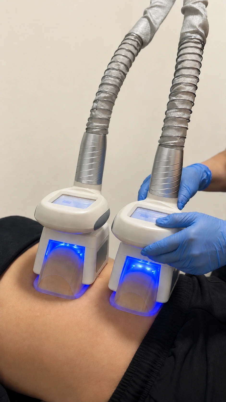 Aplicadores de criolipólisis con luz azul sobre el abdomen