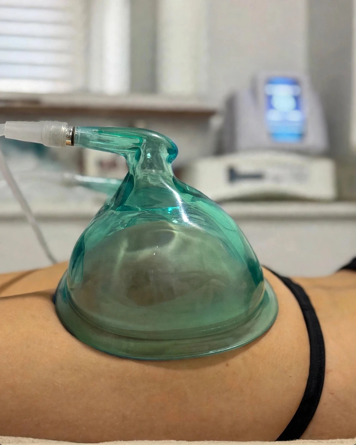 Ventosa de vacumterapia aplicada sobre el glúteo